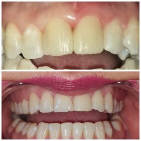 Vorher-nachher-Ergebnis Zahn-Bonding bei SoftDentalCare Clinic – bessere Farbe und Form