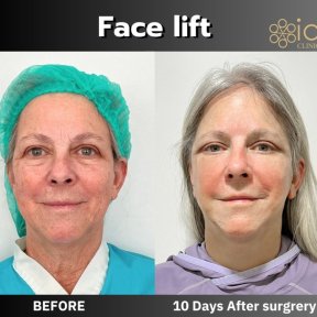 Vorher-nachher-Ergebnis Mini-Facelift bei ID Clinic Bangkok, sichtbare Verjüngung