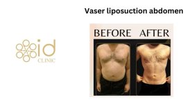 Before and after Vaser liposuction abdomen results at ID Clinic Bangkok, visible contouring