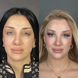 Vorher-nachher-Ergebnisse der Blepharoplastik in Prof. Dr. Furkan Karabekmez Klinik Ankara Türkei