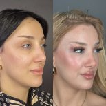 Vorher-nachher-Ergebnis der Blepharoplastik in Prof. Dr. Furkan Karabekmez Klinik, Ankara