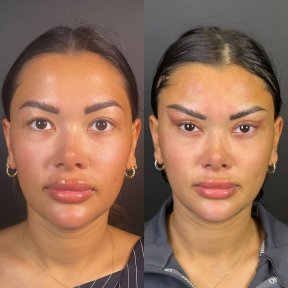 Vorher-nachher-Ergebnisse der Blepharoplastik in Prof. Dr. Furkan Karabekmez Klinik, Ankara