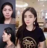 Vorher-nachher-Ergebnisse der Nasenkorrektur bei VG Plastic Surgery, Nasen- und Gesichtsoptimierung