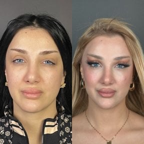 Vorher-nachher-Ergebnis Brauenlifting bei Prof. Dr. Furkan Karabekmez Klinik Ankara