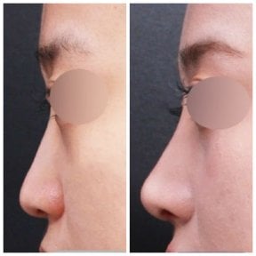 Vorher-nachher-Ergebnis der Nasenkorrektur bei VG Plastic Surgery, verbesserte Nasenkontur