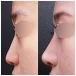 Vorher-nachher-Ergebnis der Nasenkorrektur bei VG Plastic Surgery, verbesserte Nasenkontur