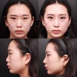 Vorher-nachher-Rhinoplastik-Ergebnisse bei VG Plastic Surgery, verbesserte Nasenform
