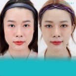 Before and after jaw shaping results at Wansiri Hospital, facial contouring improvement