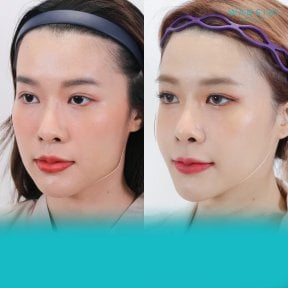 Before and after jaw shaping results at Wansiri Hospital, improved facial contour visible