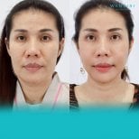 Before and after jaw shaping results at Wansiri Hospital, visible facial contour improvement