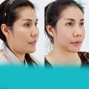 Before and after jaw shaping results at Wansiri Hospital, improved facial contour visible