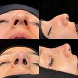 Before and after rhinoplasty results at Memorial Bahçelievler Hospital, nose reshaping outcome