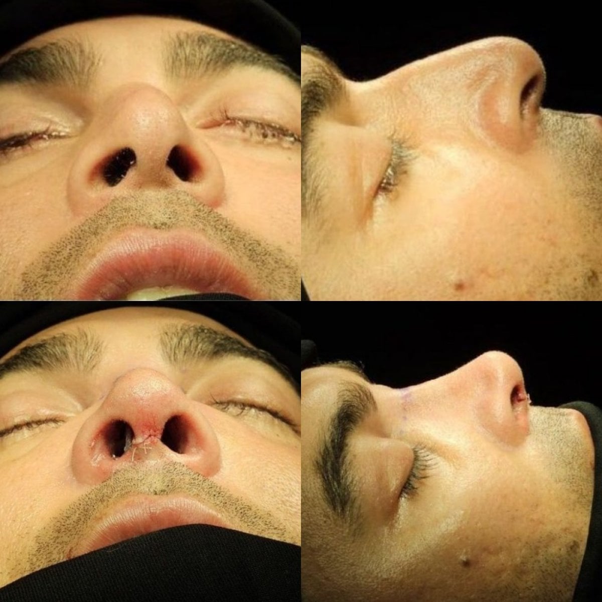Resultados de rinoplastia antes y después en Memorial Bahçelievler Hospital, forma de nariz mejorada