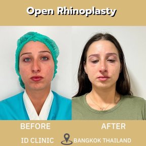 before-after photo ultrasonic-rhinoplasty