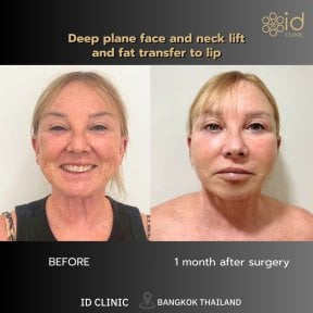 before-after photo deep-plane-facelift
