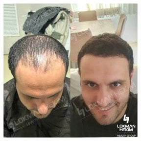Before and after hair transplant results at Lokman Hekim Istanbul Hospital, restored hairline