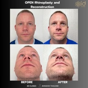 before-after photo rhinoplasty-nose-job