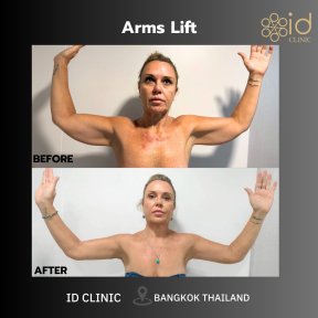 before-after photo body-lift