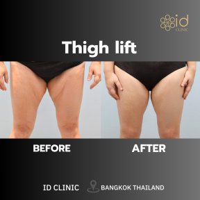 before-after photo body-lift