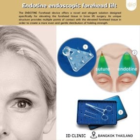 before-after photo deep-plane-facelift