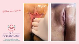 Vorher-nachher-Ergebnisse der Labioplastik in Dr. Esra Cabuk Comerts Klinik, verbesserte Optik