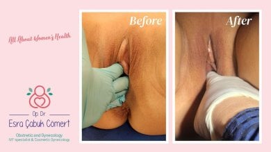 Vorher-nachher-Ergebnisse der Labioplastik in Dr. Esra Cabuk Comerts Klinik, verbesserte Optik