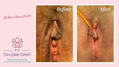 Vorher-nachher-Ergebnisse der Labiaplastik in Dr. Esra Cabuk Comerts Klinik, Schamlippenkorrektur
