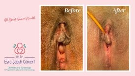 Vorher-nachher-Ergebnisse der Labiaplastik in Dr. Esra Cabuk Comerts Klinik, Schamlippenkorrektur