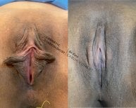 Vorher-nachher-Ergebnisse der Labioplastik in Dr. Esra Cabuk Comerts Klinik, verbesserte Schamlippen