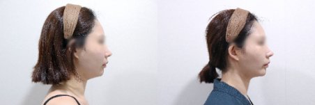 نتائج قبل وبعد علاج Ultherapy في عيادة Lalian Cheongdam – شد واضح للوجه