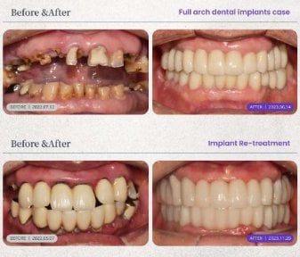Efekty przed i po implantacji zębów w 365SeoulOneTop365 Dental Clinic, pełna rekonstrukcja