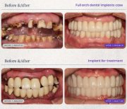 Efekty przed i po implantacji zębów w 365SeoulOneTop365 Dental Clinic, pełna rekonstrukcja