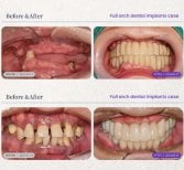 Before and after full arch dental implant results at 365SeoulOneTop365 Dental Clinic