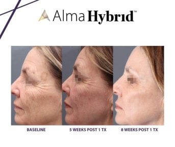 Результати CO2-лазерного лікування в Alpha Beauty Hannover – омолодження шкіри обличчя за 8 тижнів