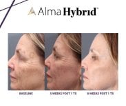 Результати CO2-лазерного лікування в Alpha Beauty Hannover – омолодження шкіри обличчя за 8 тижнів