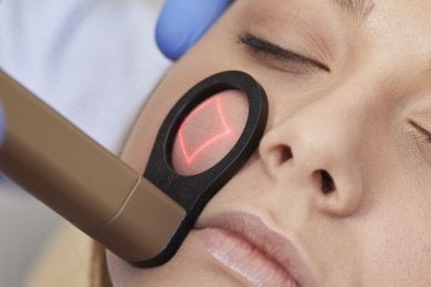 CO2-лазерне омолодження обличчя в Alpha Beauty Hannover для покращення шкіри