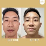 Vorher-nachher-Rhinoplastik-Ergebnisse bei ID Clinic Bangkok, verbesserte Nasenform