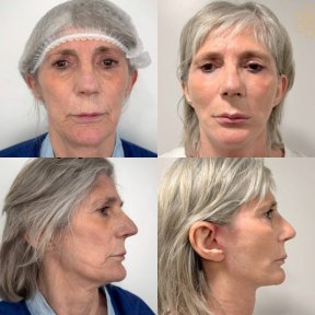 Deep Plane Facelift Vorher-Nachher-Ergebnisse bei ID Clinic Bangkok, sichtbare Verjüngung