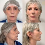 Deep Plane Facelift Vorher-Nachher-Ergebnisse bei ID Clinic Bangkok, sichtbare Verjüngung