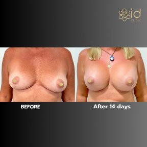 Vorher-nachher Brustimplantate mit Straffung bei ID Clinic Bangkok, Ergebnis nach 14 Tagen
