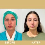 Vorher-nachher-Ergebnis der Ultraschall-Rhinoplastik in der ID Clinic Bangkok, Nasenkorrektur