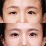 Блефаропластика до и после в VG Plastic Surgery – улучшение формы век