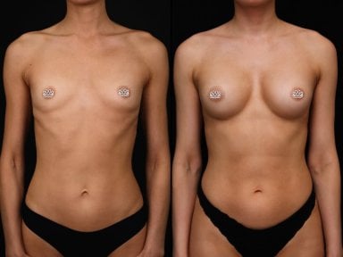 Before and after breast augmentation results at Vidnova Clinic, enhanced breast shape