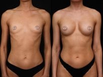Before and after breast augmentation results at Vidnova Clinic, enhanced breast shape
