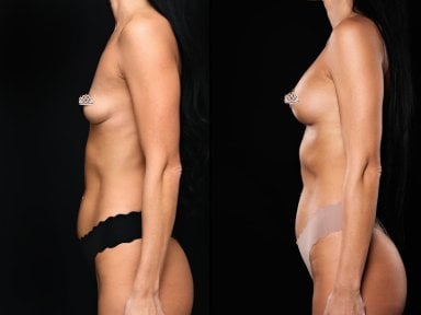 Before and after breast augmentation results at Vidnova Clinic – enhanced breast volume