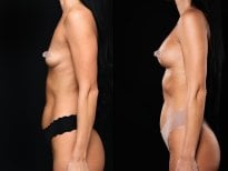Before and after breast augmentation results at Vidnova Clinic – enhanced breast volume