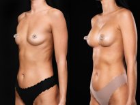 Before and after breast augmentation results at Vidnova Clinic – enhanced breast volume