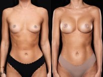 Before and after breast augmentation results at Vidnova Clinic – enhanced breast volume