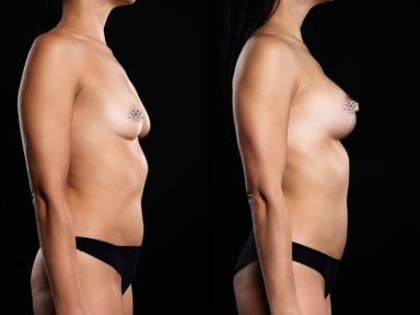 Resultados antes y después de aumento de senos en Vidnova Clinic – forma mejorada del busto