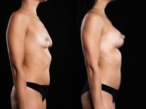 Resultados antes y después de aumento de senos en Vidnova Clinic – forma mejorada del busto